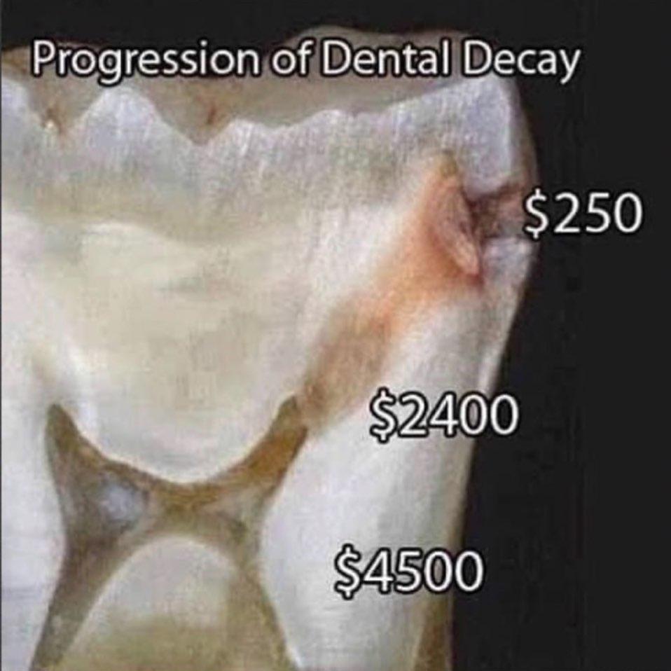 Progression of Dental Decay