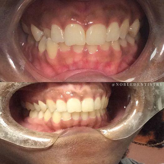 Invisalign Results at 6 months