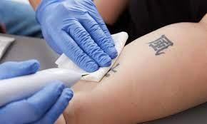Commons Reasons for Laser Tattoo Removal