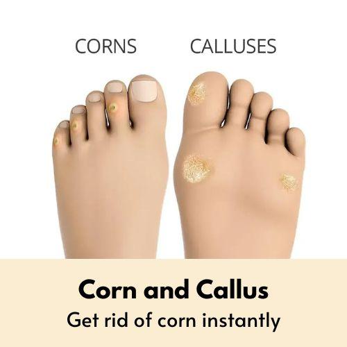 How should corns on the foot be treat from evidence-based medic