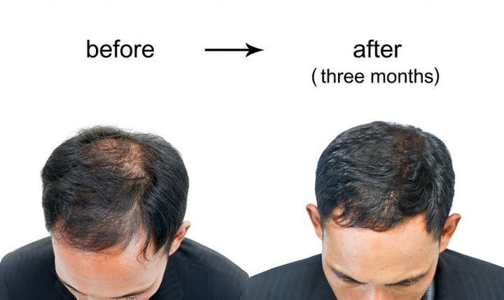 What can we do to stop baldness? 