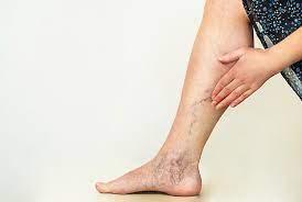 A Short Guide To Varicose Vein Treatment