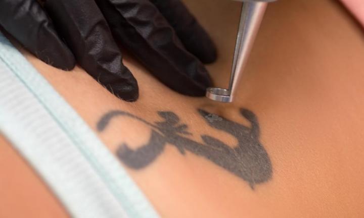 Laser Tattoo Removal - A Few Frequently Asked Questions