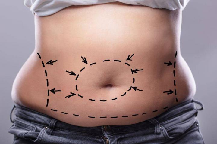 Good Things About Laser Liposuction Surgery