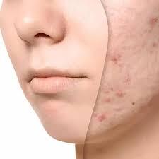 Laser Acne Scar Removal Treatment