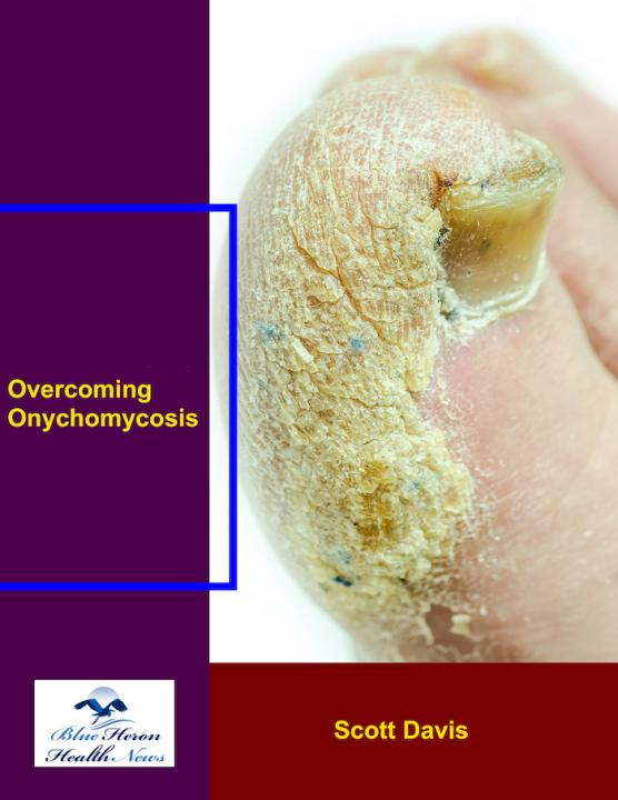 Overcoming Onychomycosis eBook PDF Download
