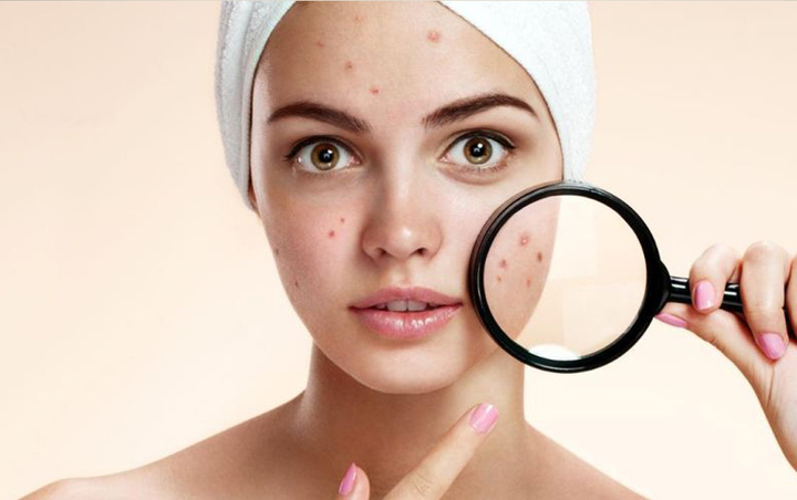 5 Awesome Home Remedies for Acne Treatment