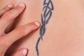 Want to Get Rid Of Unwanted Tattoos? Try Laser Tattoo Removal!