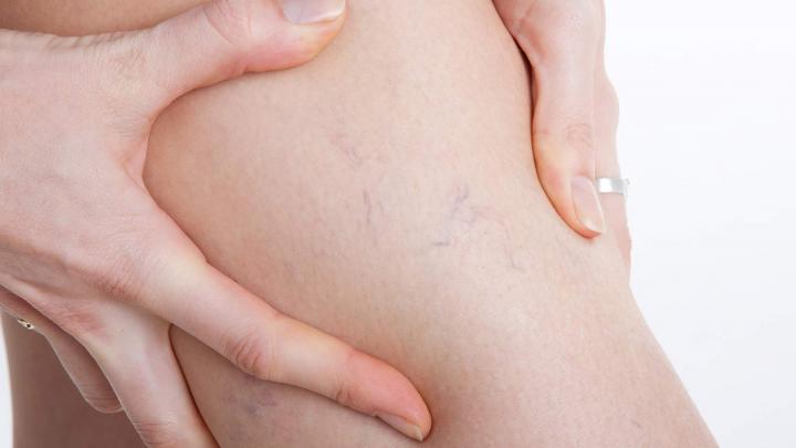 Pros and Cons of Laser Treatment For Spider Veins