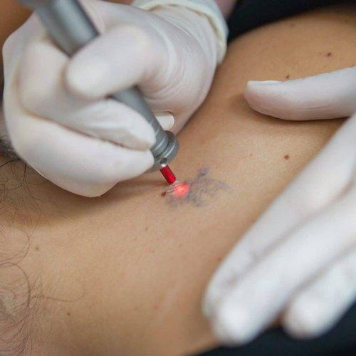 How Laser Tattoo Removal Works