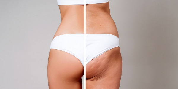 Treatment of cellulite with PRP (platelet rich plasma) - prpmed.