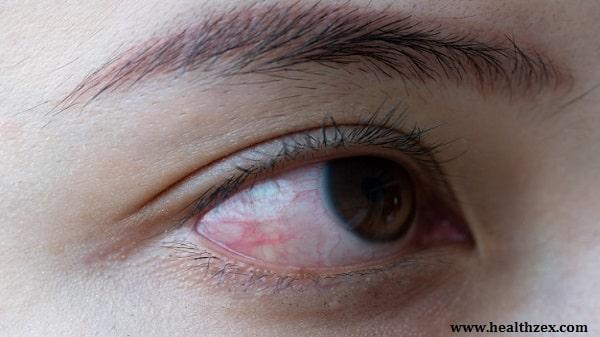 Eye Allergies: Causes, symptoms and treatment | Healthzex